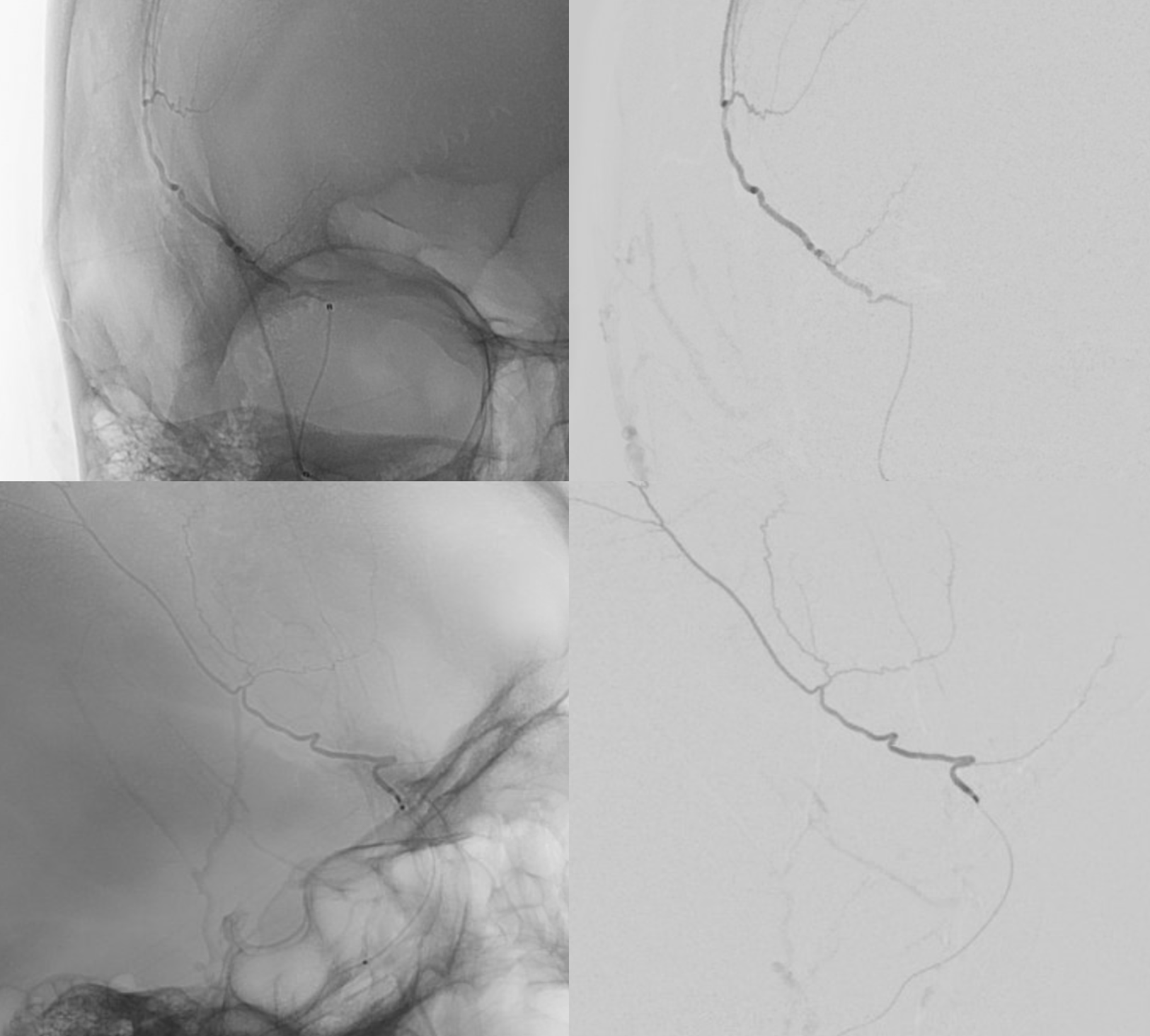 Subdural Embolization Multiple Orbital Anastomoses nBCA Technique